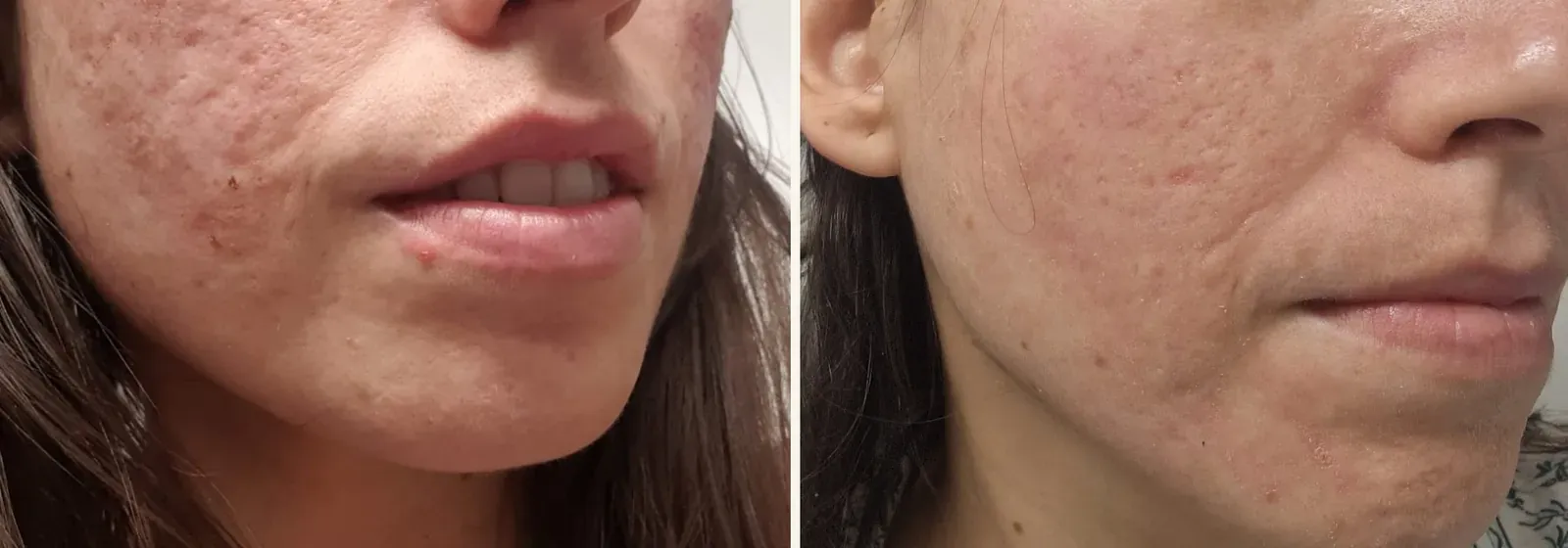 Cicatrices y acné activo · antes y después