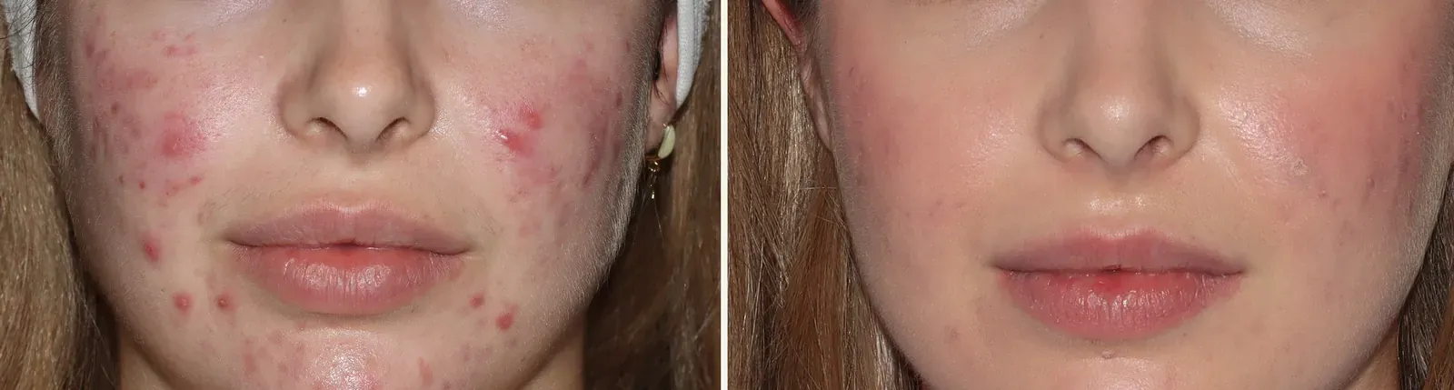 Cicatrices y acné activo · antes y después