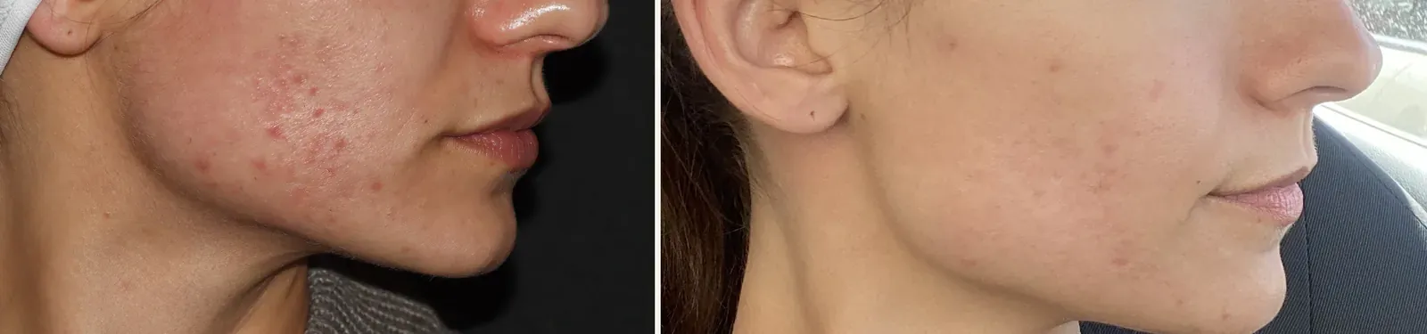 Cicatrices y acné activo · antes y después