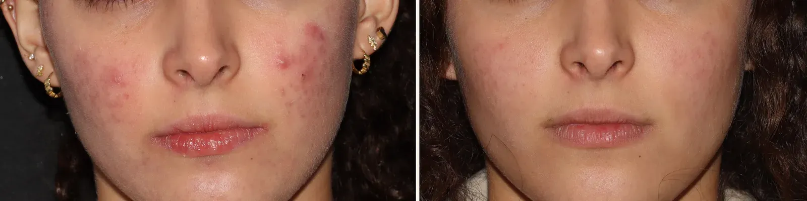 Cicatrices y acné activo · antes y después