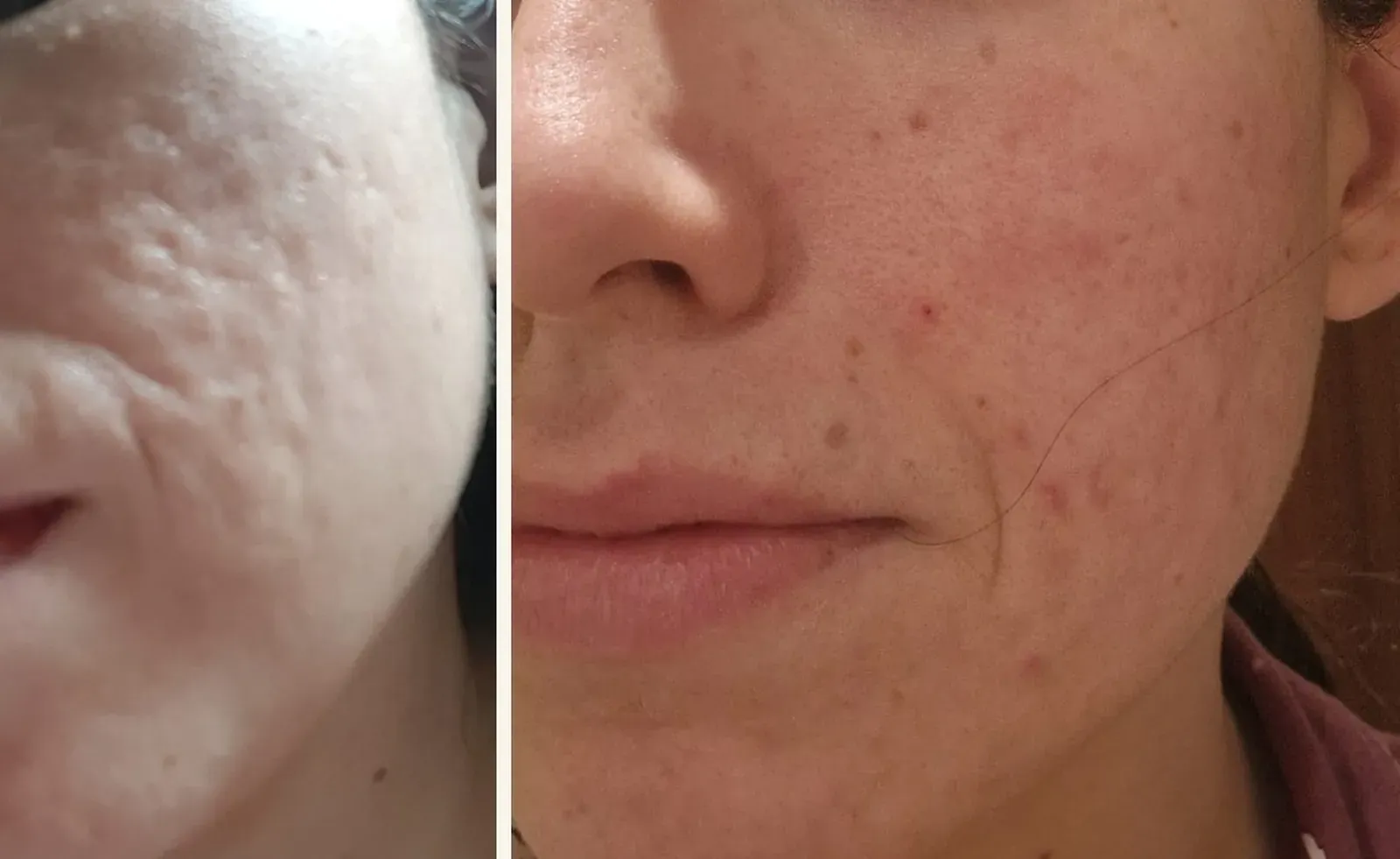 Cicatrices y acné activo · antes y después