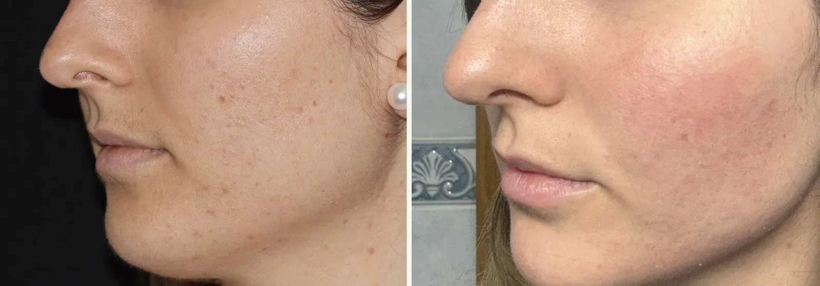 Cicatrices y acné activo · antes y después