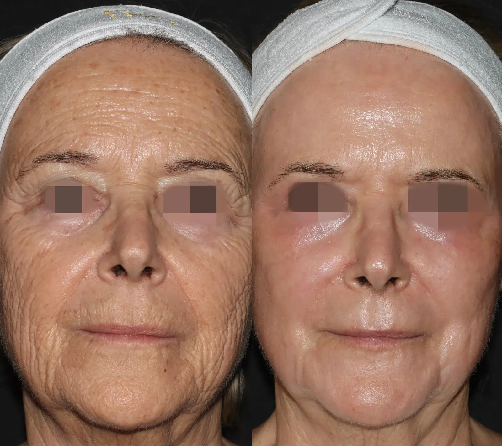 Resurfacing con láser de CO₂ · antes y después