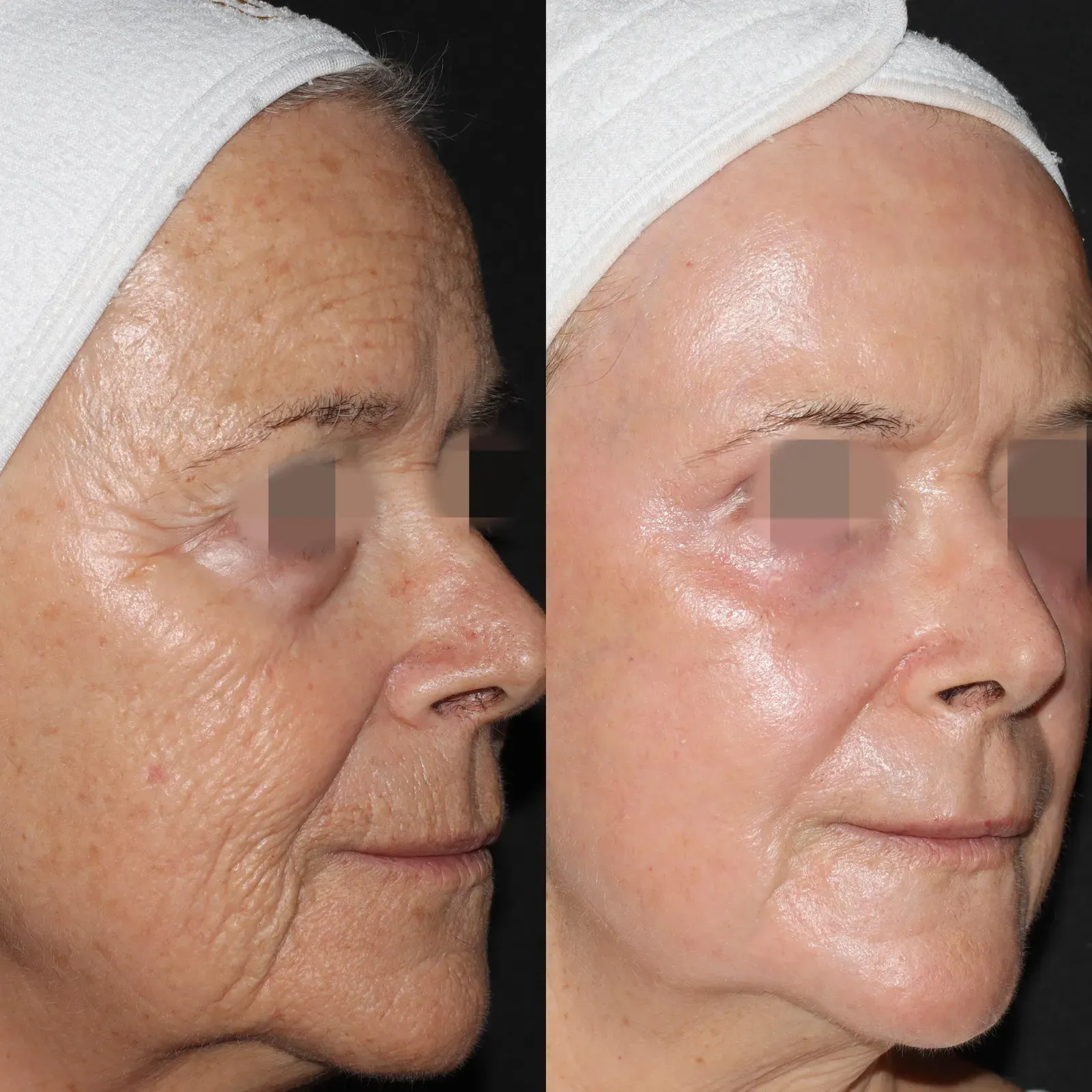 Resurfacing con láser de CO₂ · antes y después