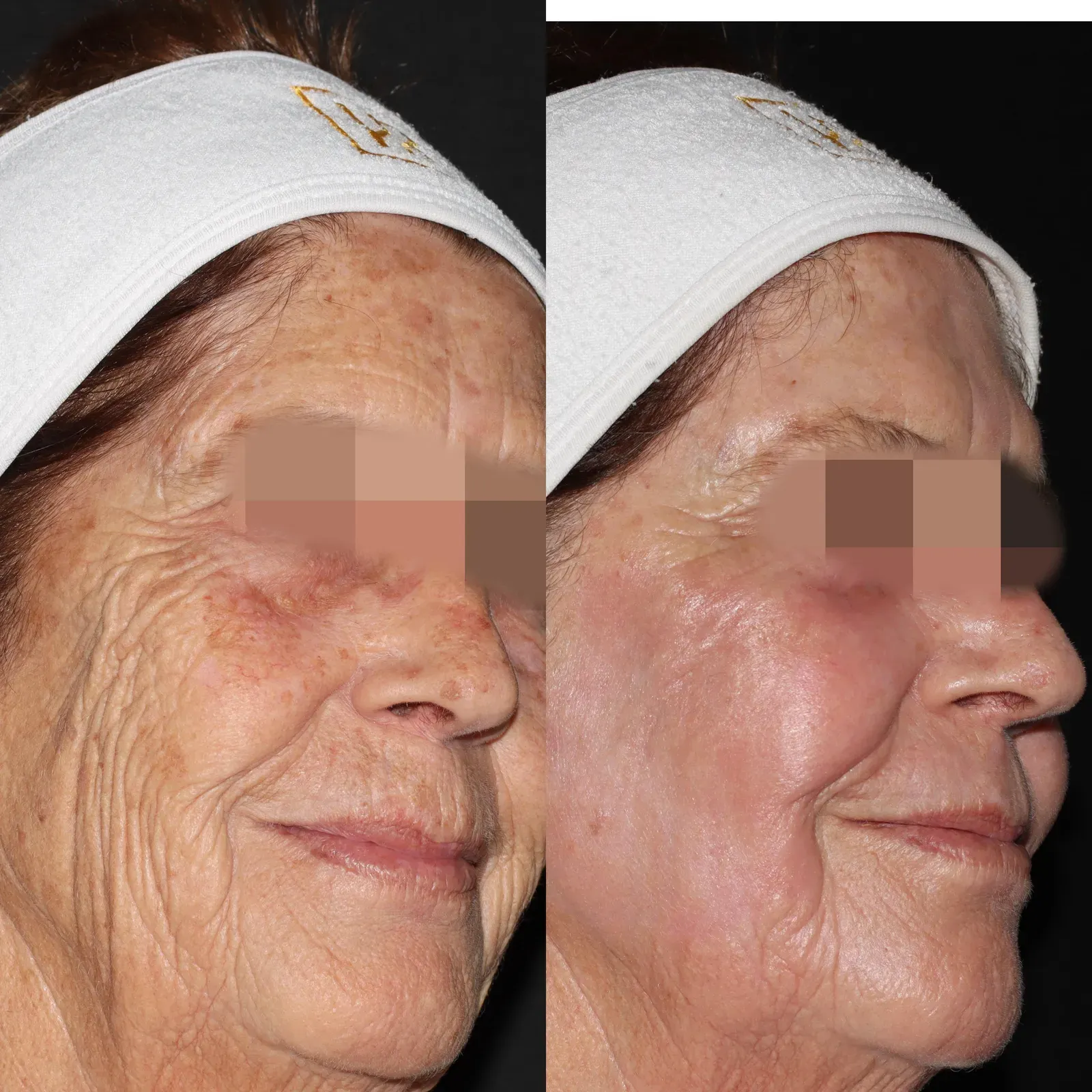 Resurfacing con láser de CO₂ · antes y después