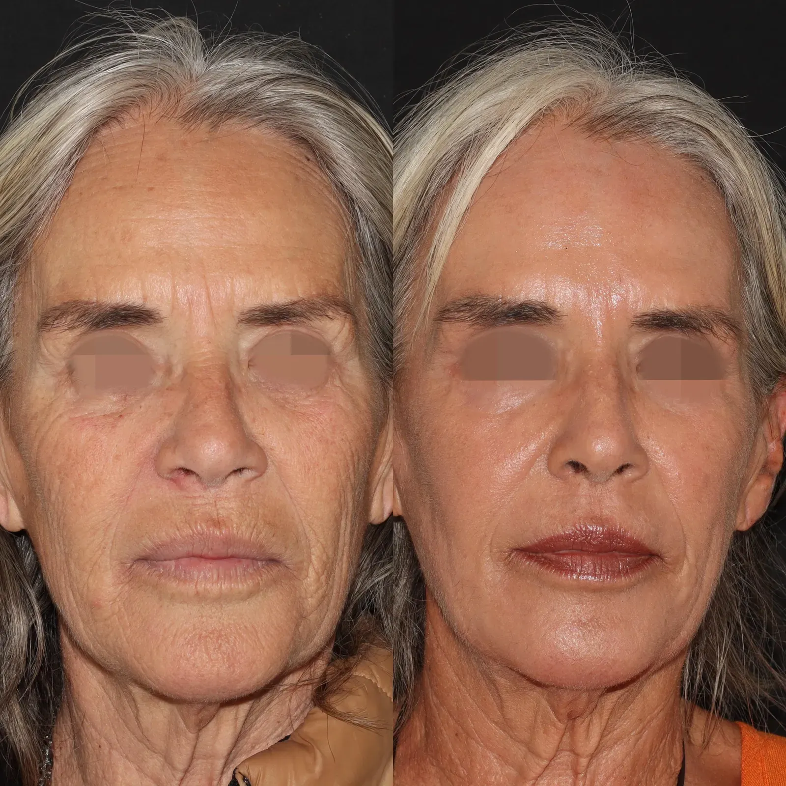 Resurfacing con láser de CO₂ · antes y después