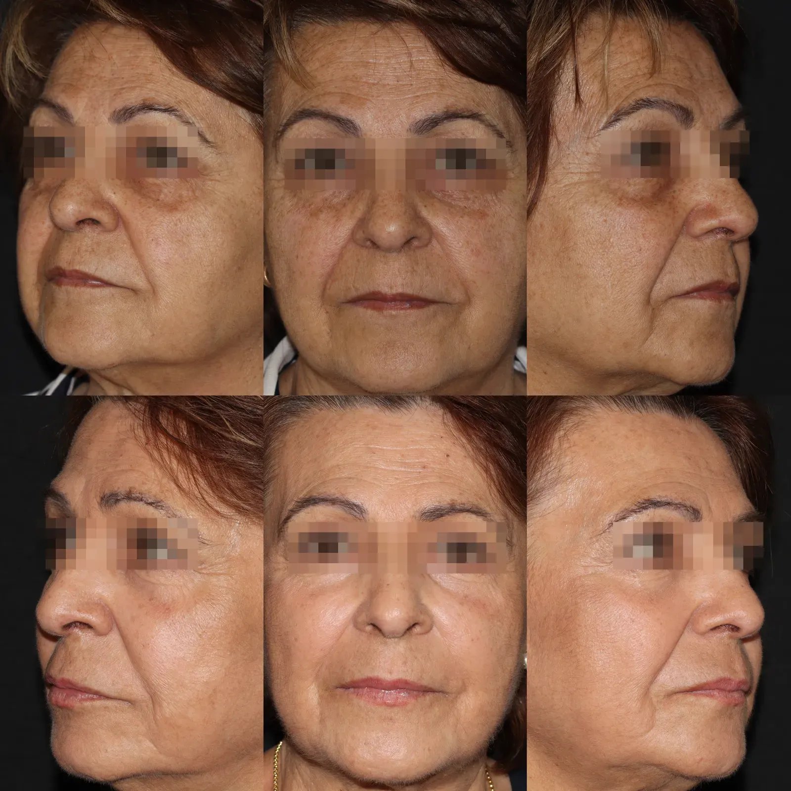 Resurfacing con láser de CO₂ · antes y después