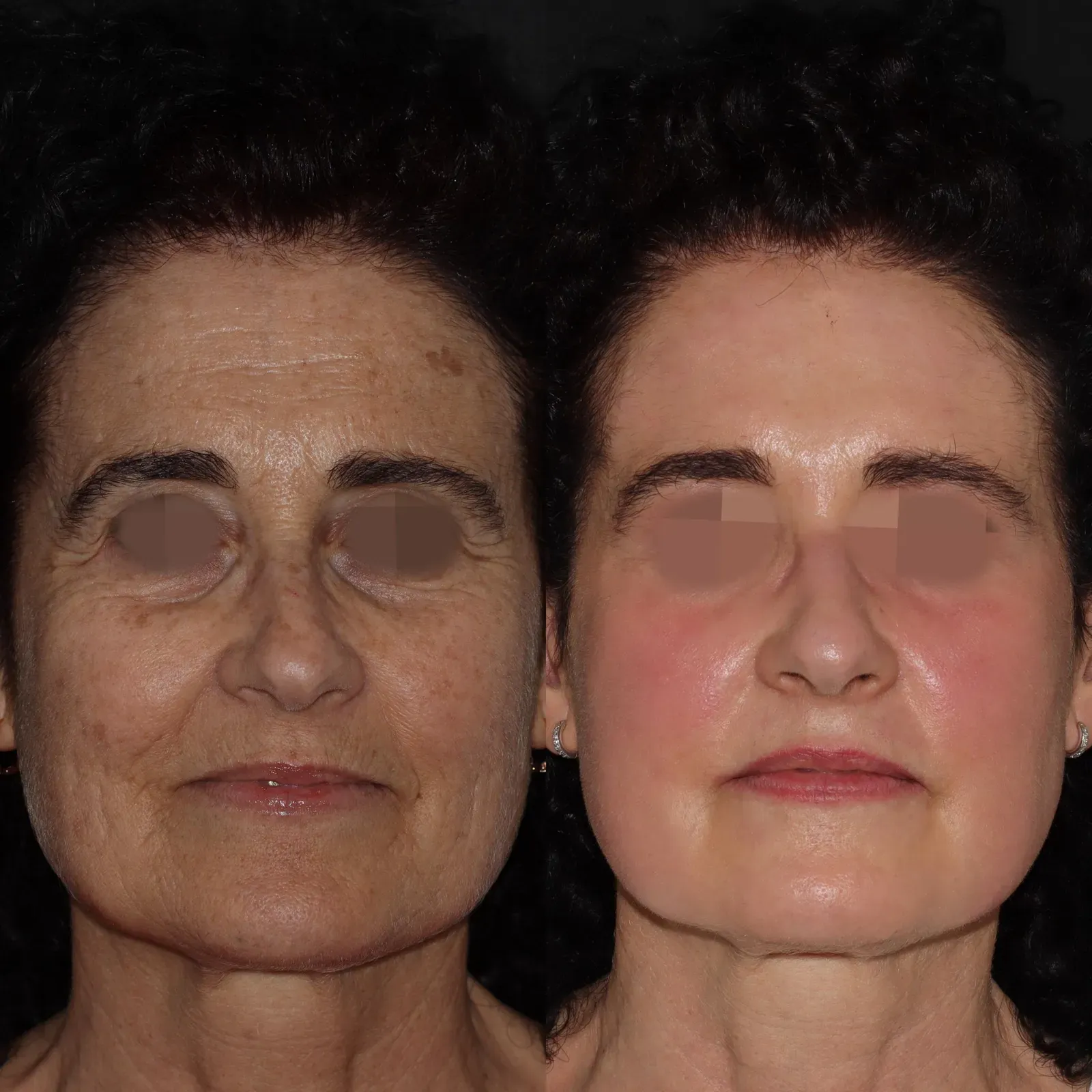 Resurfacing con láser de CO₂ · antes y después