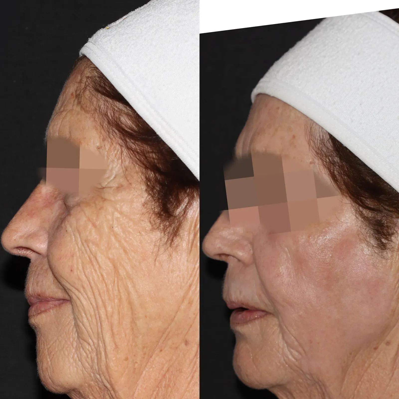Resurfacing con láser de CO₂ · antes y después
