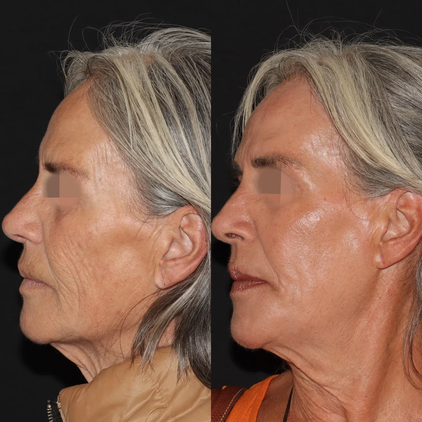 Resurfacing con láser de CO₂ · antes y después