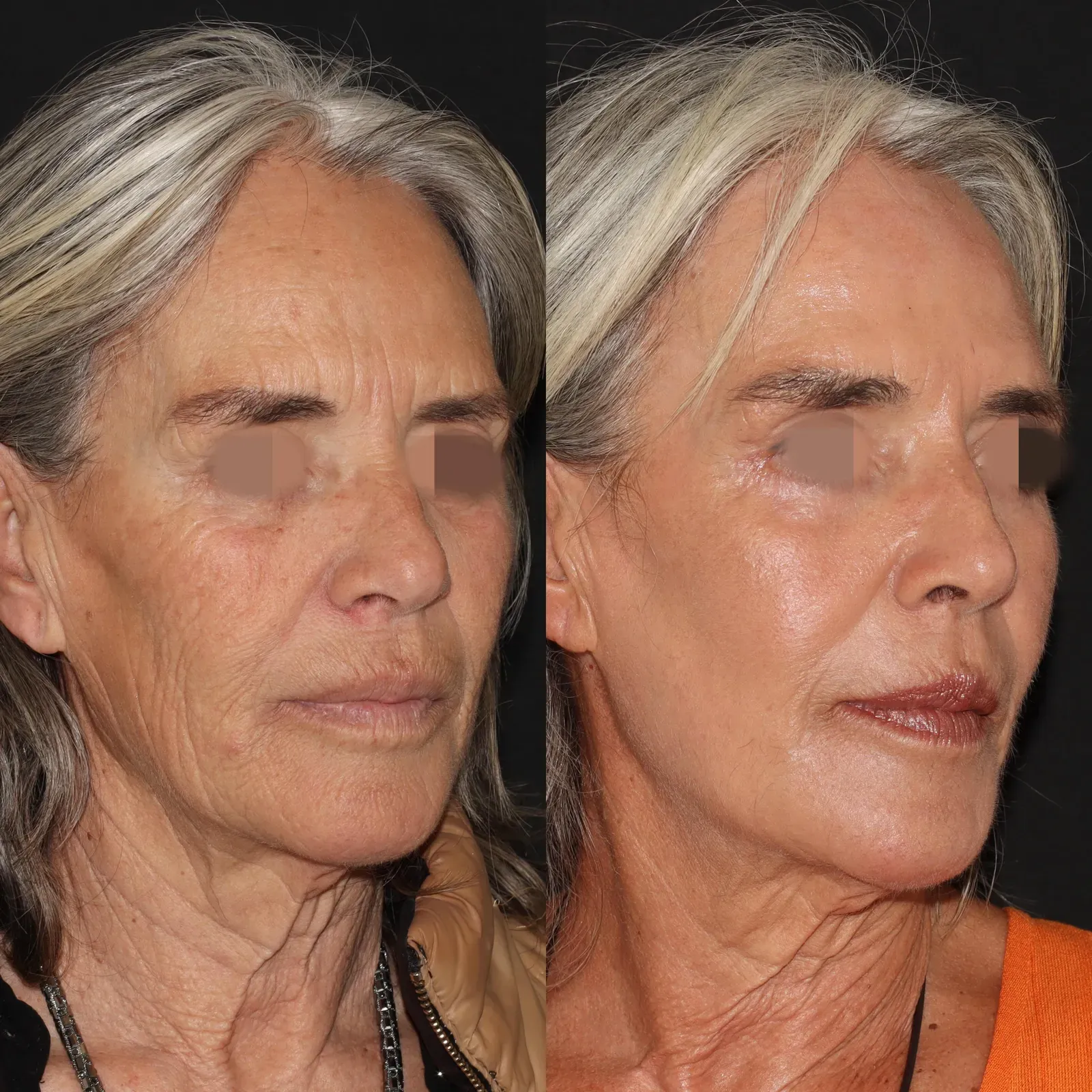 Resurfacing con láser de CO₂ · antes y después