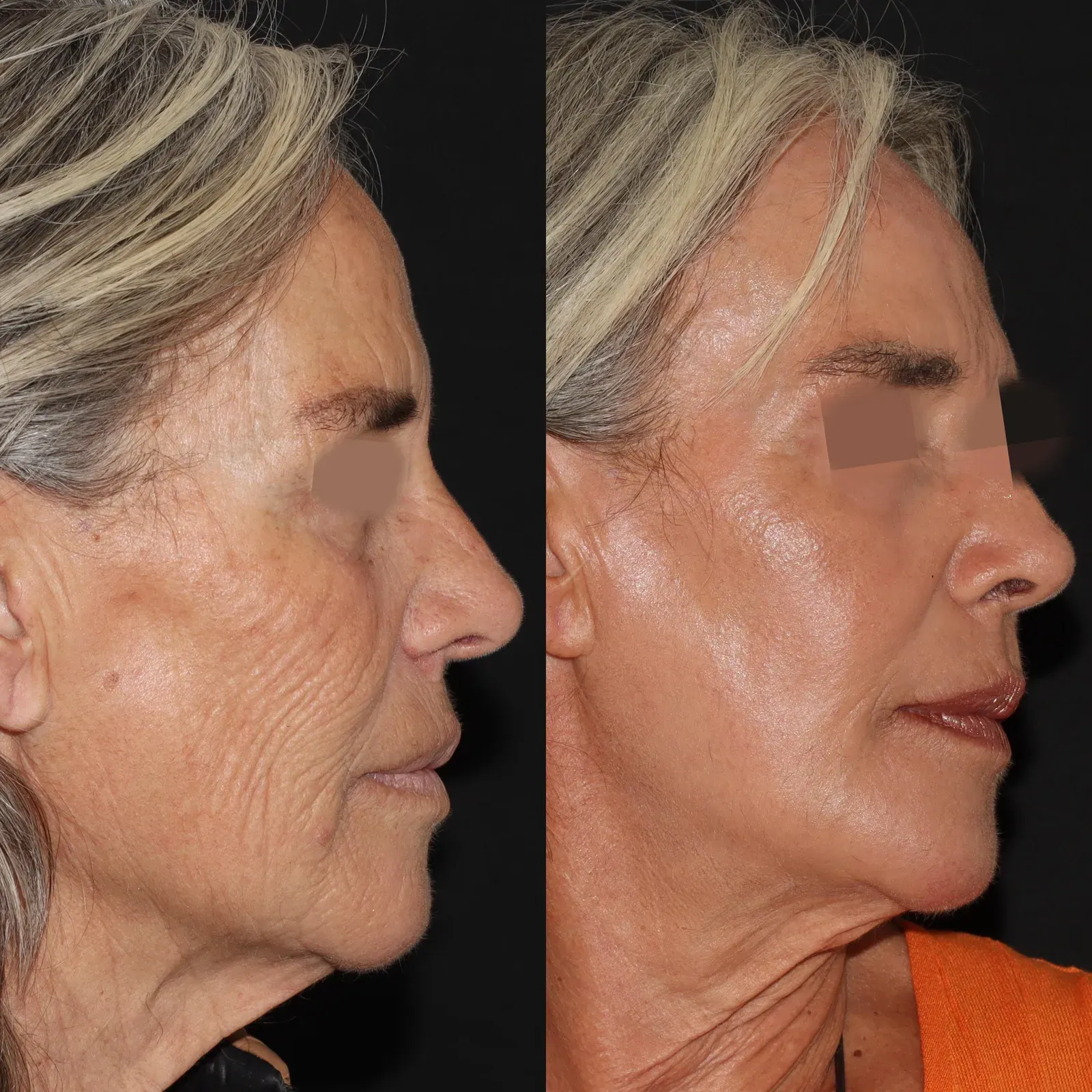Resurfacing con láser de CO₂ · antes y después