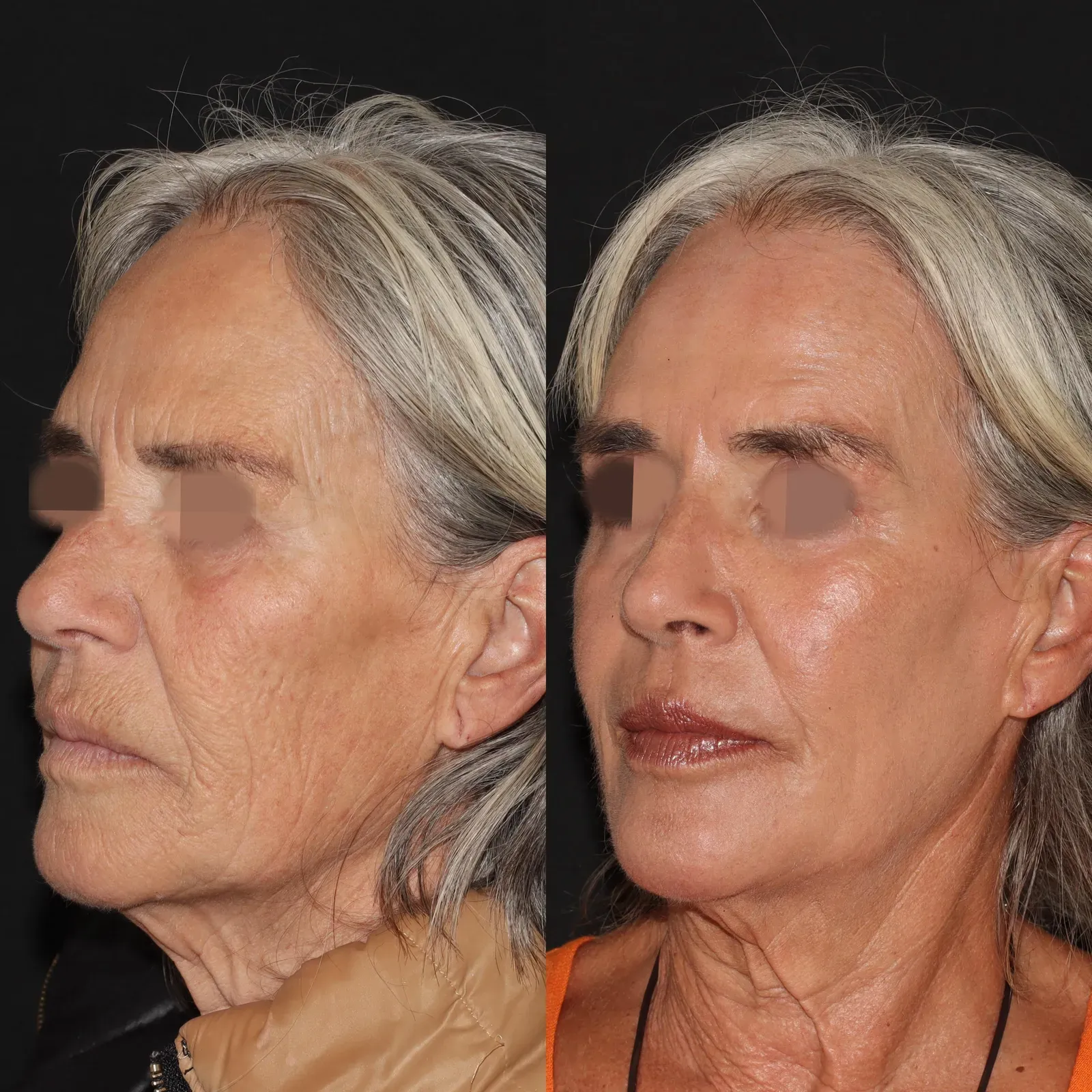 Resurfacing con láser de CO₂ · antes y después