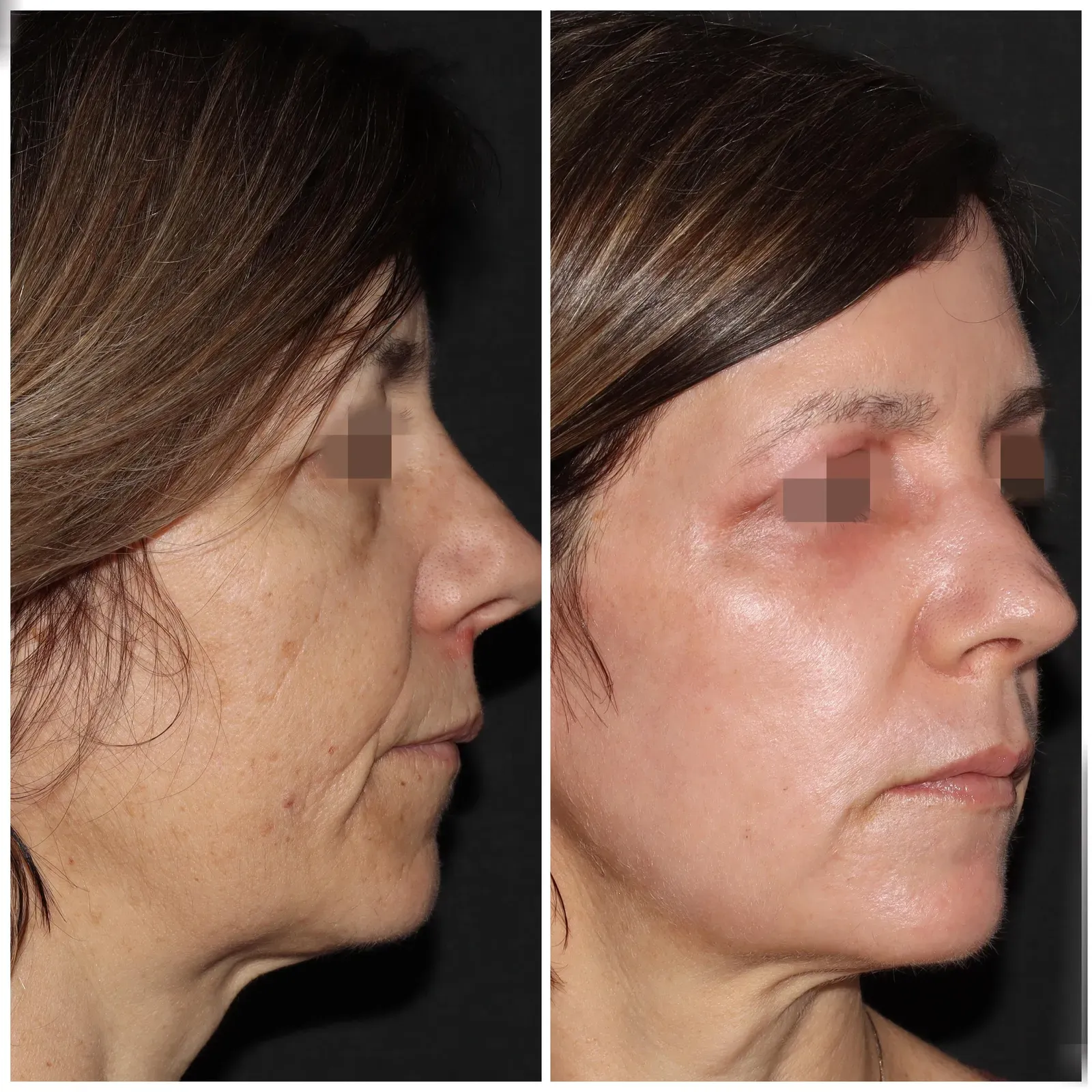 Resurfacing con láser de CO₂ · antes y después