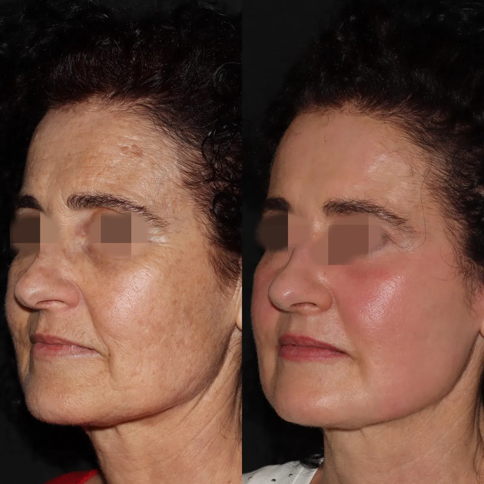 Resurfacing con láser de CO₂ · antes y después