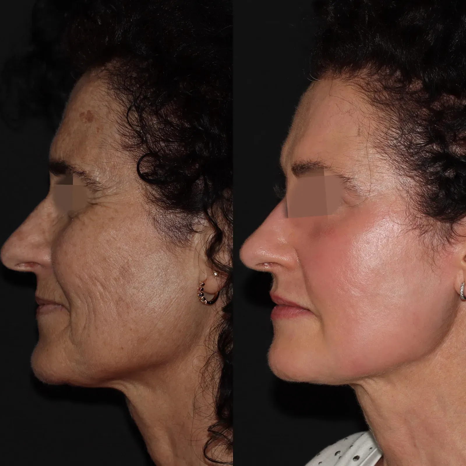 Resurfacing con láser de CO₂ · antes y después