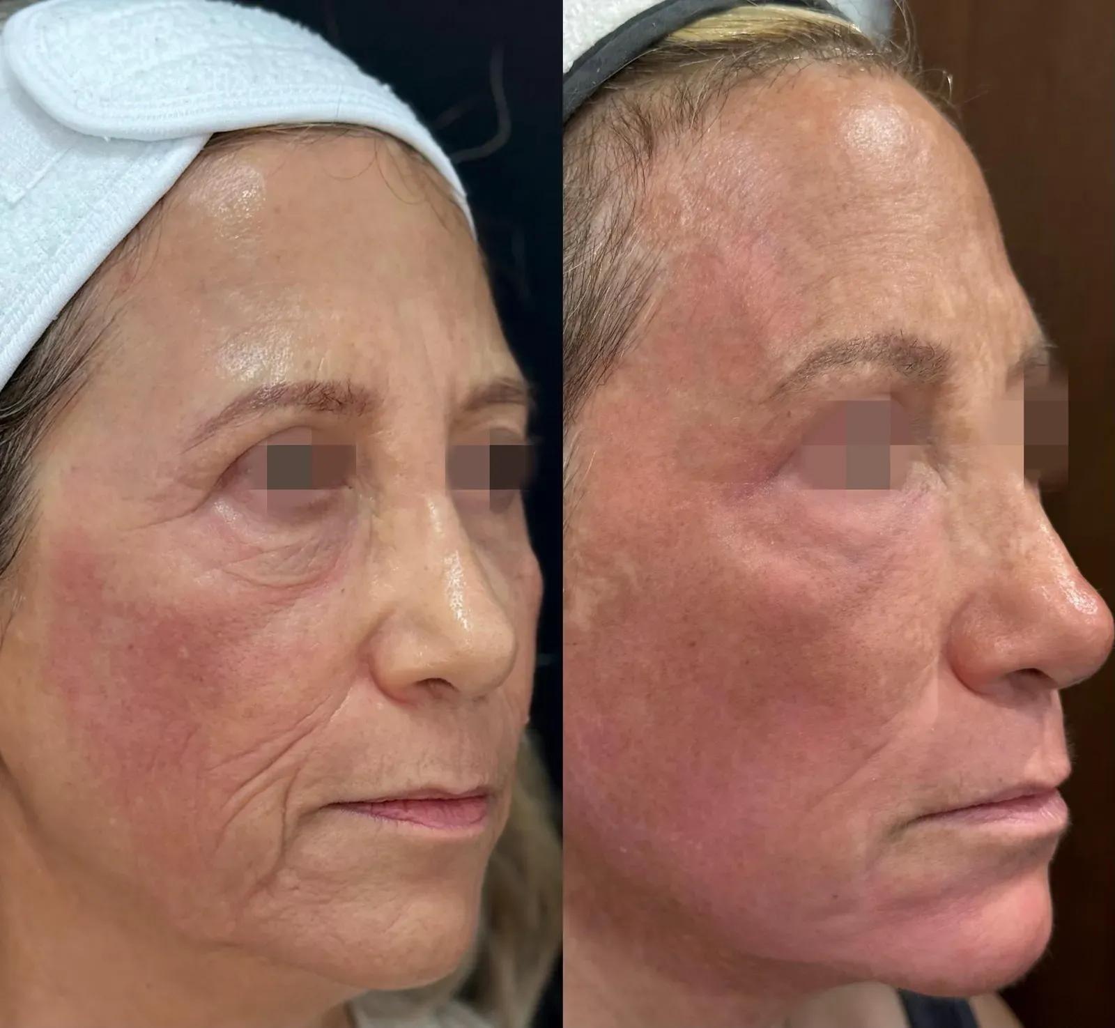 Resurfacing con láser de CO₂ · antes y después