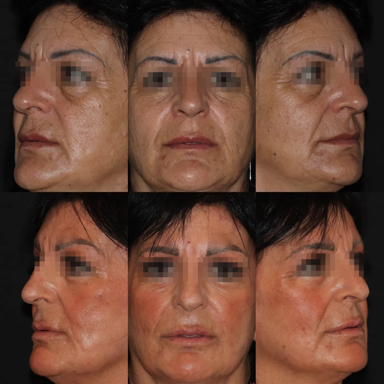 Resurfacing con láser de CO₂ · antes y después