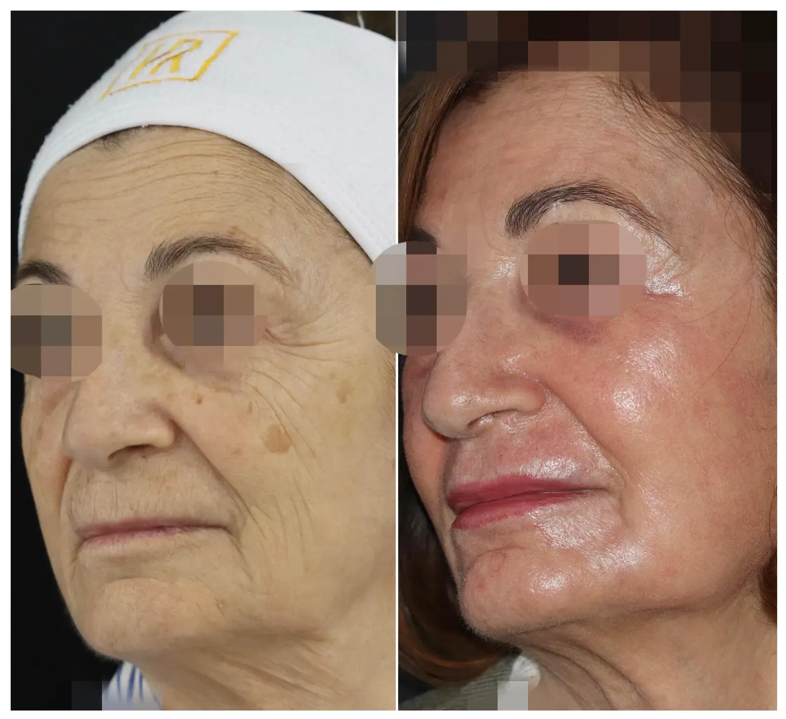Resurfacing con láser de CO₂ · antes y después