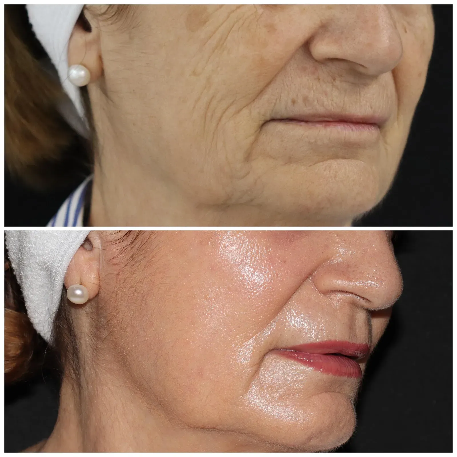 Resurfacing con láser de CO₂ · antes y después · detalle perioral
