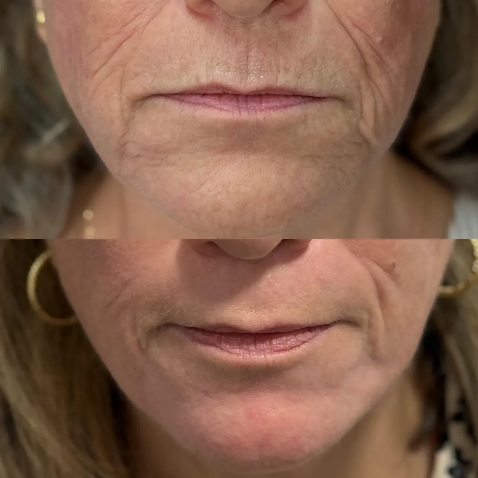 Resurfacing con láser de CO₂ · antes y después · detalle perioral