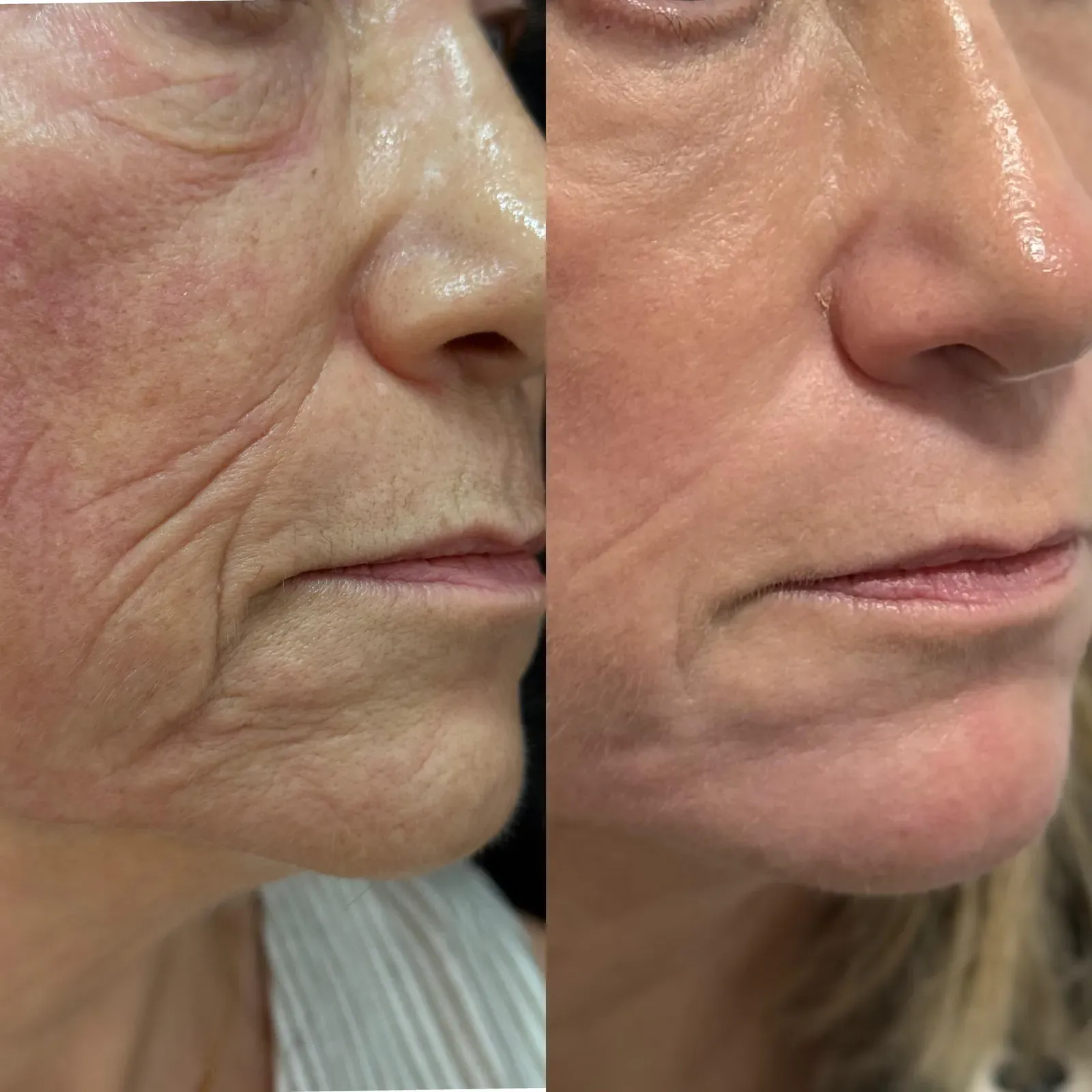 Resurfacing con láser de CO₂ · antes y después · detalle perioral