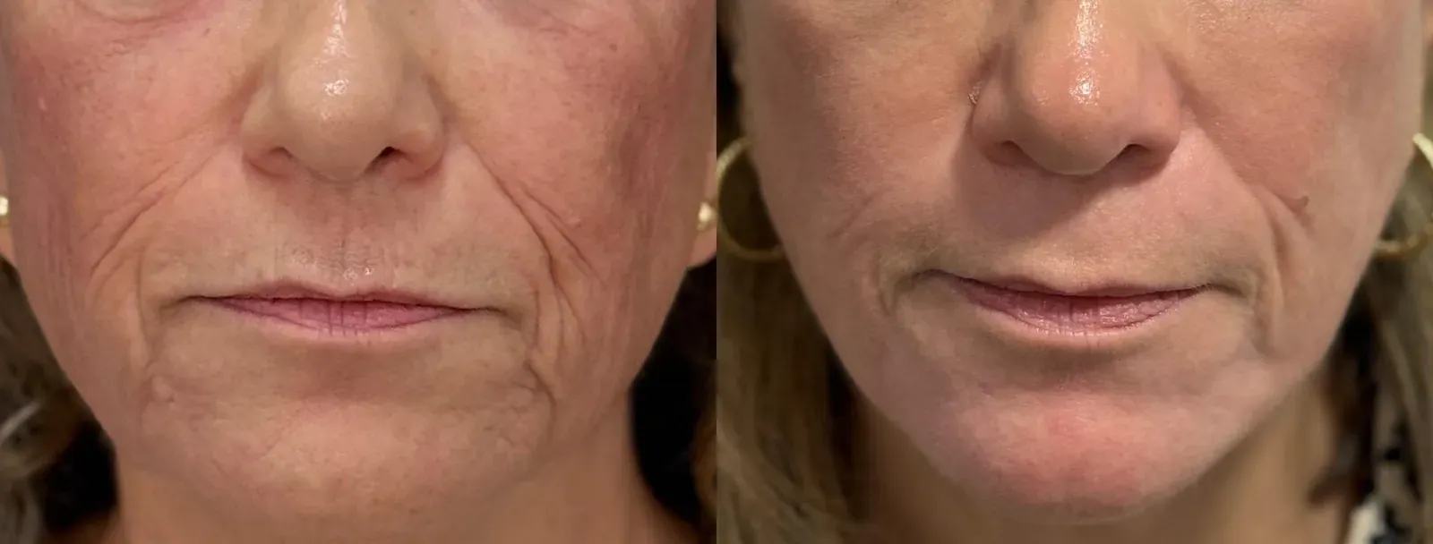 Resurfacing con láser de CO₂ · antes y después · detalle perioral